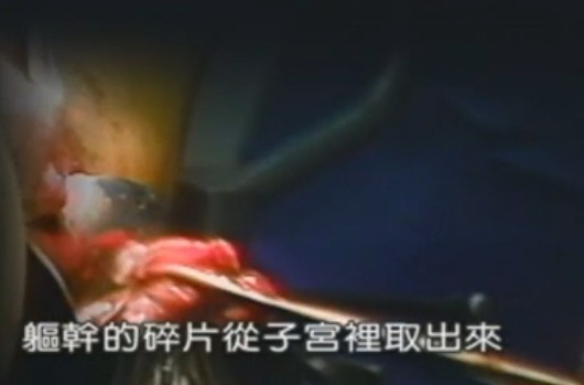 危险重重 直击人流手术全过程